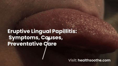 Eruptive Lingual Papillitis_ Symptoms, Causes, Preventative Care