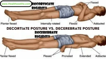 decorticate posturing Vs. decerebrate posturing - Healthsoothe