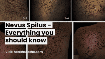 Nevus Spilus - Everything You Should Know