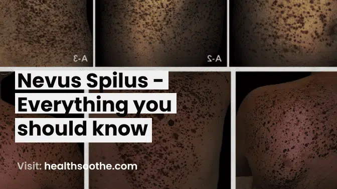 Nevus Spilus - Everything you should know