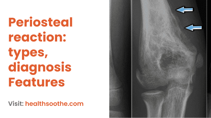 Periosteal Reaction_ Types, Diagnosis Features