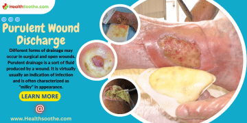 Purulent drainage - Healthsoothe