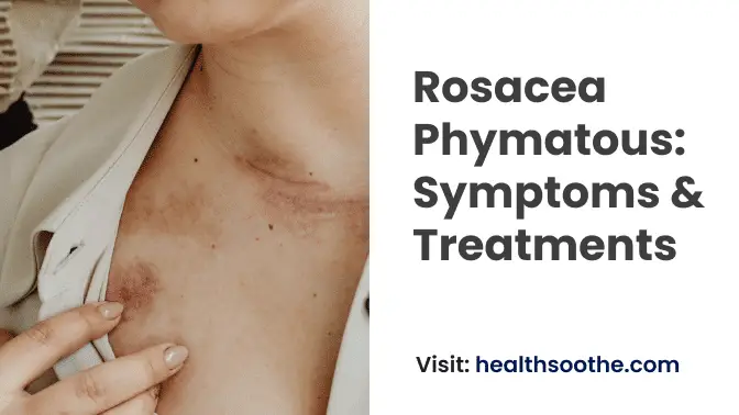 Rosacea Phymatous - Symptoms & Treatments