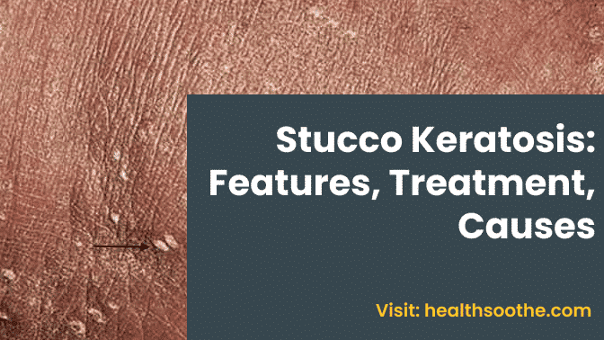 Stucco Keratosis_ Features, Treatment, Causes