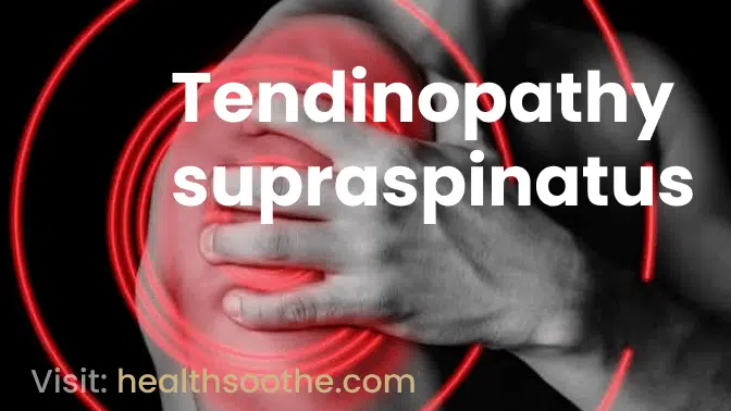 Tendinopathy supraspinatus, Causes, symptoms.