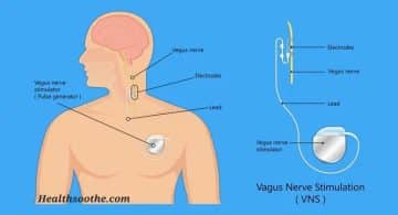 Unlocking The Secret to Chronic Pain Relief: Vagus Nerve Stimulation