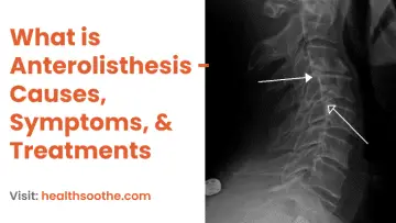What is Anterolisthesis - Causes, Symptoms, & Treatments