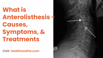 What is Anterolisthesis - Causes, Symptoms, & Treatments