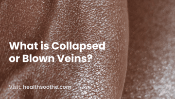 What is Collapsed or Blown Veins