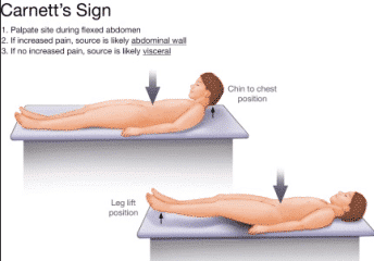 carnetts sign - Healthsoothe