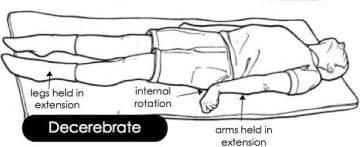 decerebrate posture - Healthsoothe