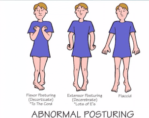 Abnormal Posturing: Decorticate Posturing And Decerebrate Posturing - Healthsoothe