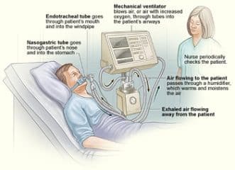 mechanical ventilator - Healthsoothe