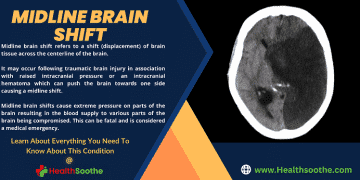 Midline Brain Shift - Healthsoothe