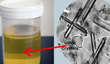 crystals in urine - Healthsoothe