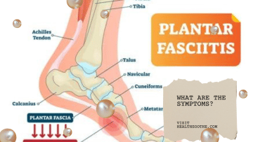 Plantar Fasciitis: What Are the Symptoms?
