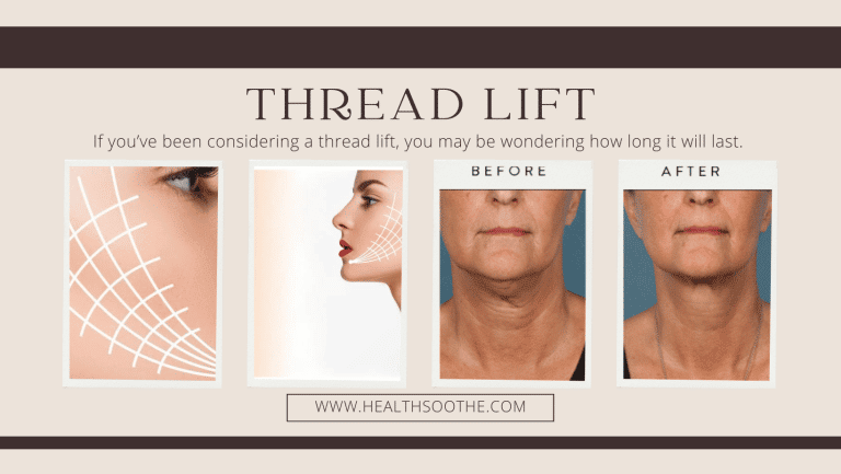 How Long Does a Thread Lift Last?