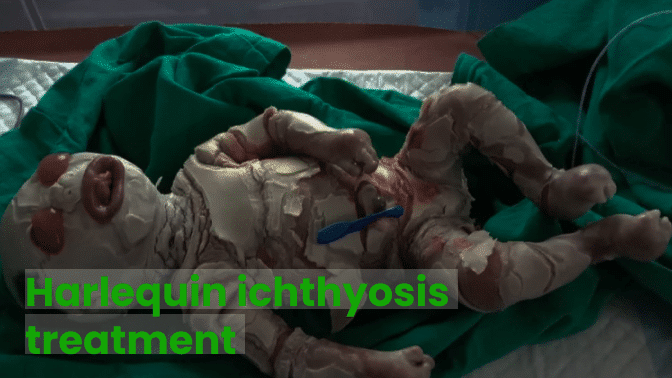 Harlequin ichthyosis treatment