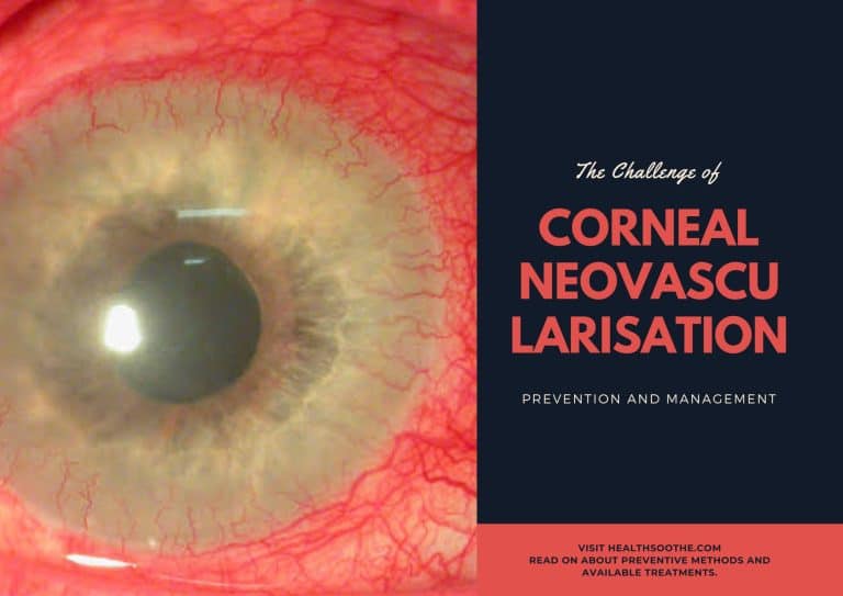 The Challenge of Corneal Neovascularisation: Prevention and Management
