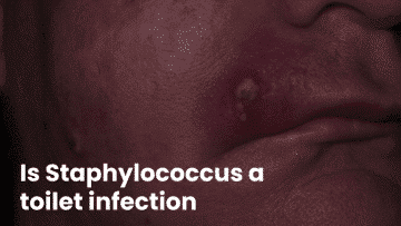 Is Staphylococcus a toilet infection