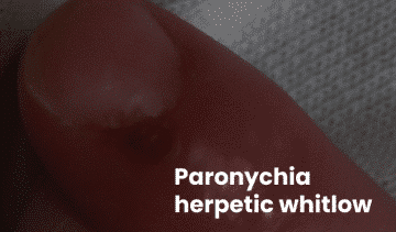 Paronychia Herpetic Whitlow