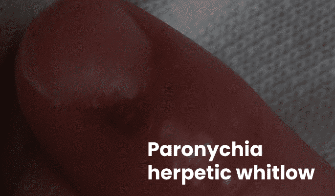 Paronychia Herpetic Whitlow