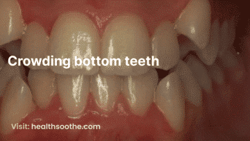 Crowding bottom teeth