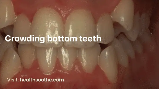 Crowding bottom teeth