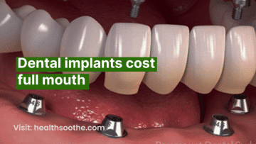 Dental implants cost full mouth