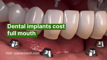 Dental implants cost full mouth