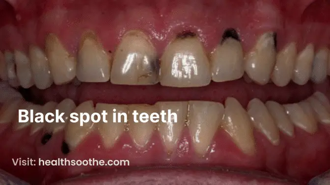 Black Spots in Teeth