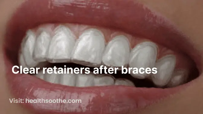 clear retainers after braces