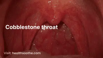 cobblestone throat