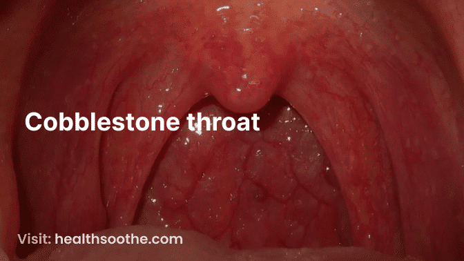 cobblestone throat