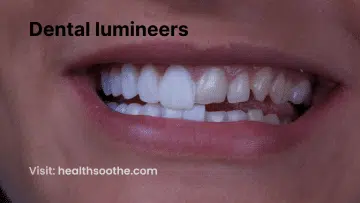 dental lumineers