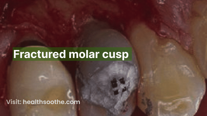 fractured molar cusp