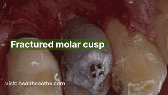 Fractured Molar Cusp