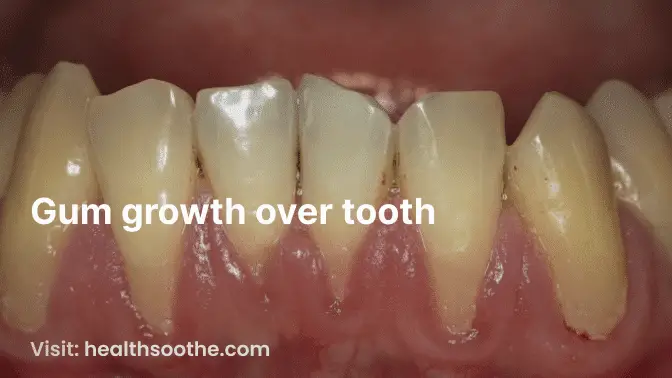 gum growth over tooth