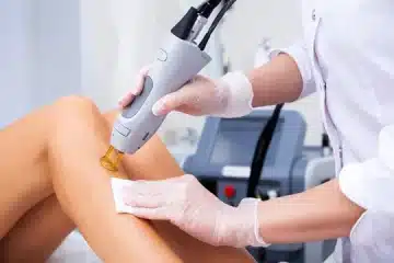 How to choose the best professionals for laser hair removal?