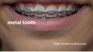 metal tooth