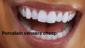 porcelain veneers cheap