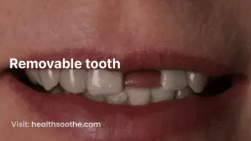 removable tooth