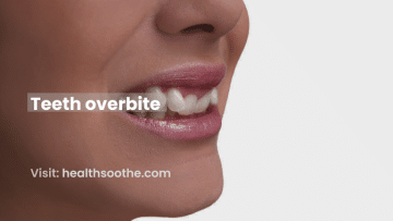 Teeth Overbite
