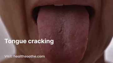 tongue cracking