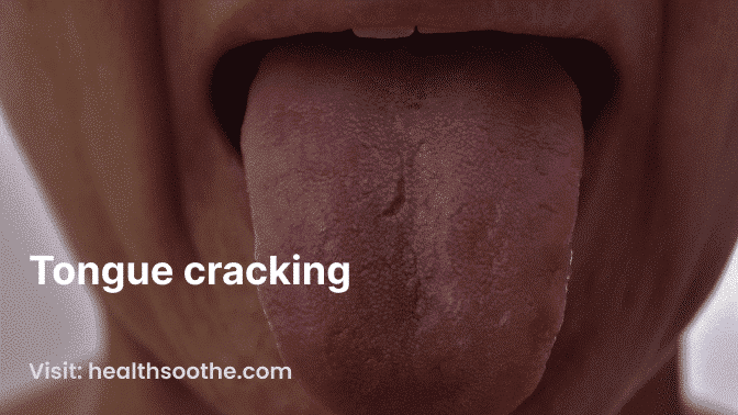 Tongue Cracking