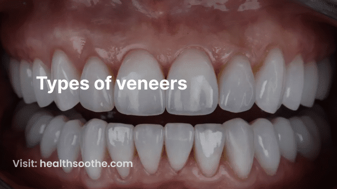 types of veneers