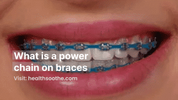 what is a power chain on braces