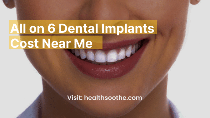 All on 6 Dental Implants Cost Near Me