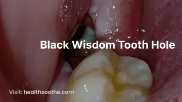 Black Wisdom Tooth Hole