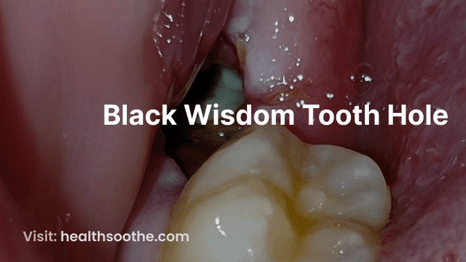 Black Wisdom Tooth Hole